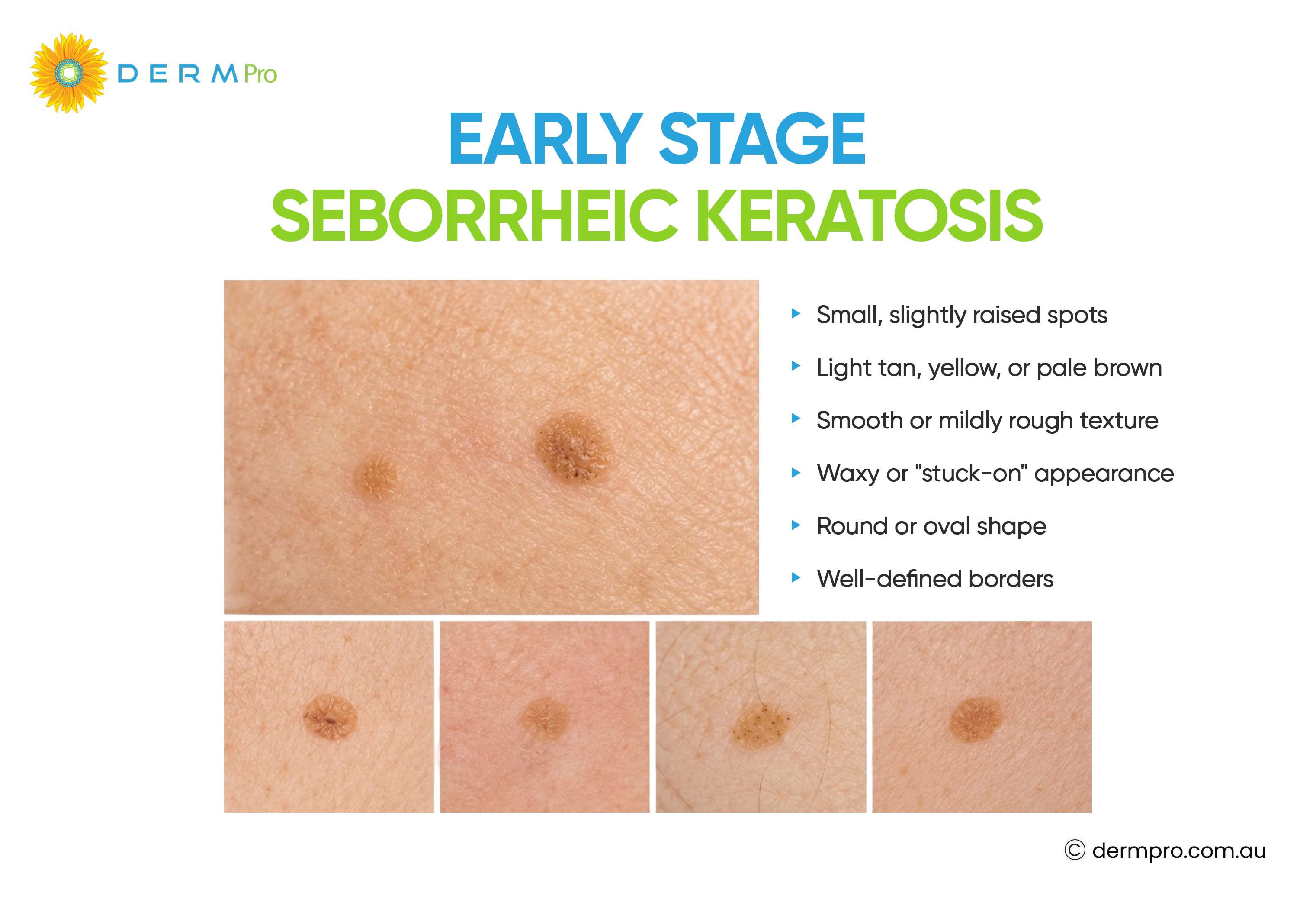 Early Stage Seborrheic Keratosis